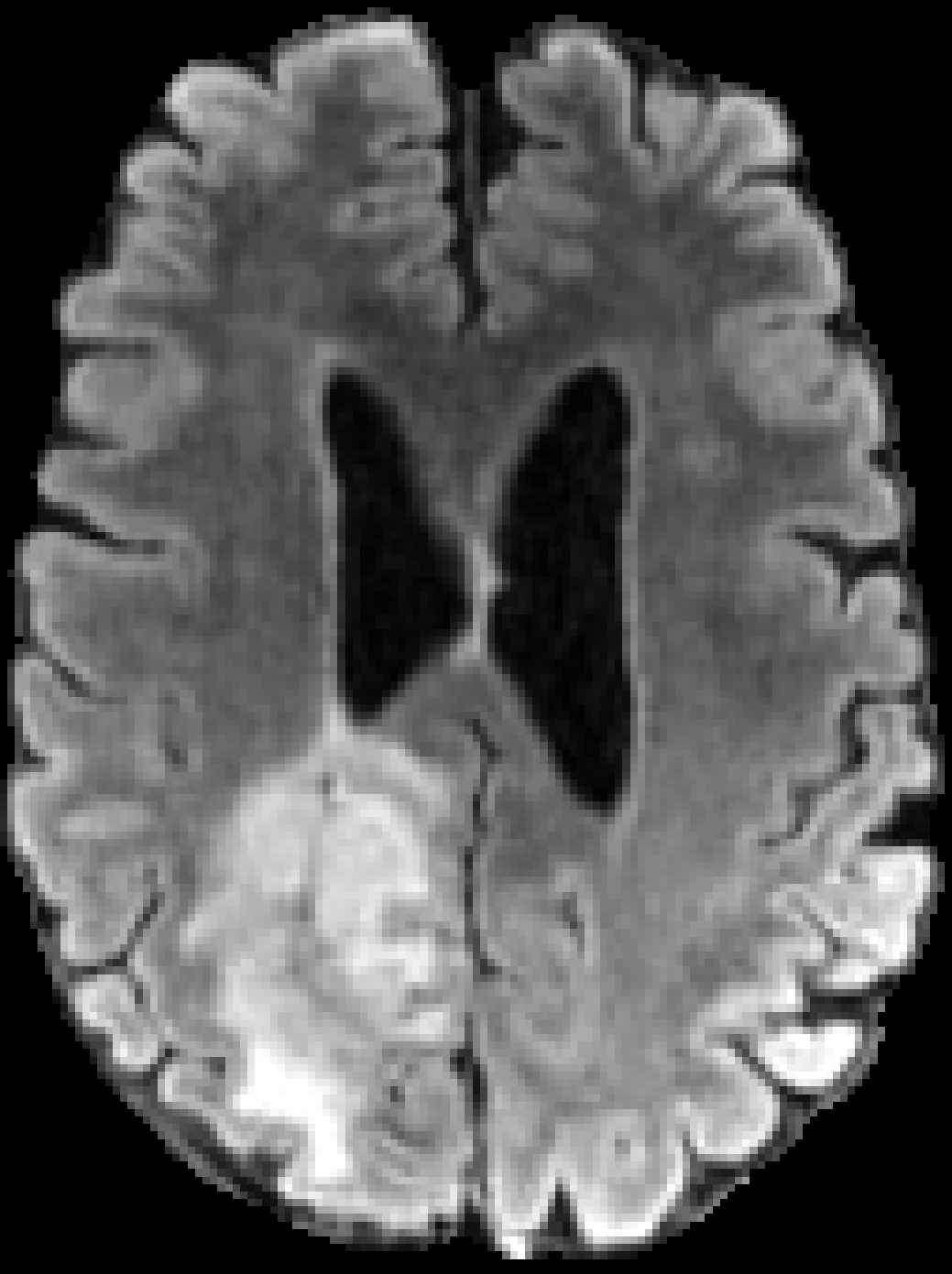 BraTS glioma, FLAIR input