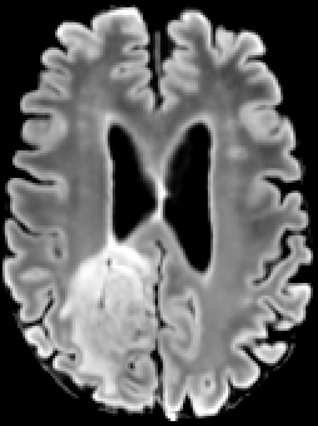 BraTS glioma, FLAIR denoised with YADO