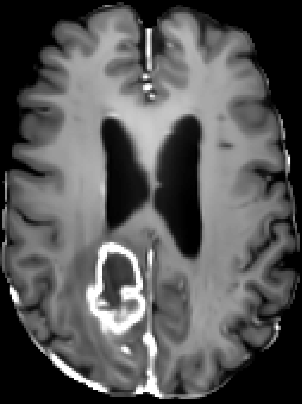 BraTS glioma, contrast-enhanced T1w denoised with YADO