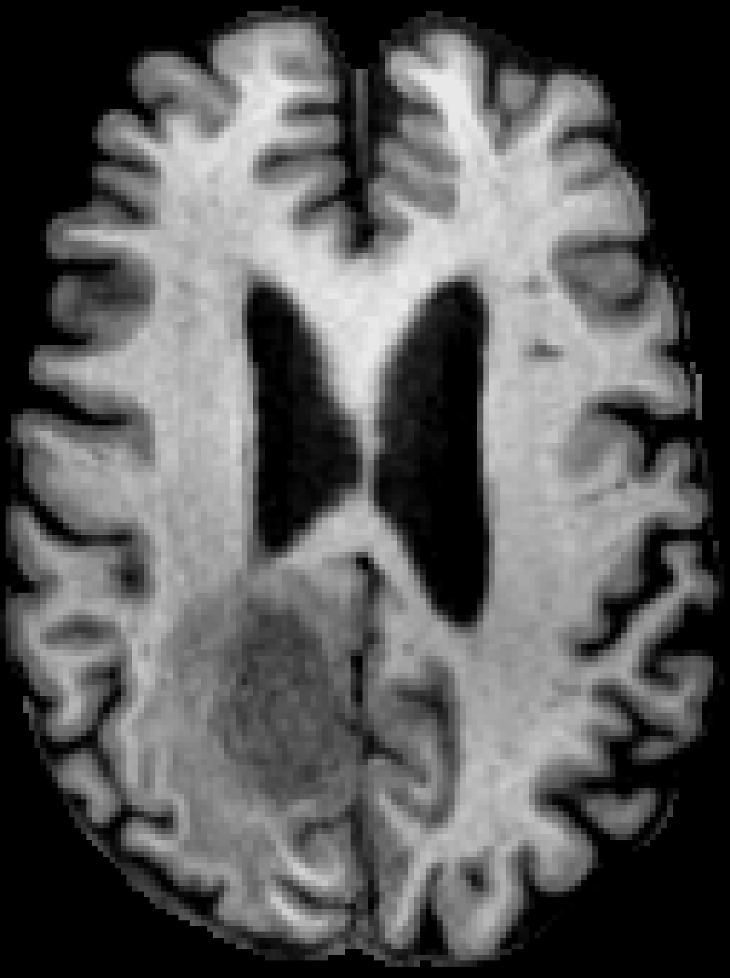 BraTS glioma, T1w input