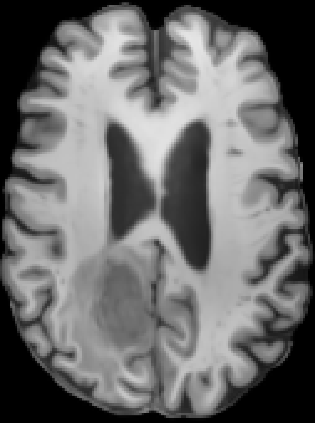 BraTS glioma, T1w denoised with YADO