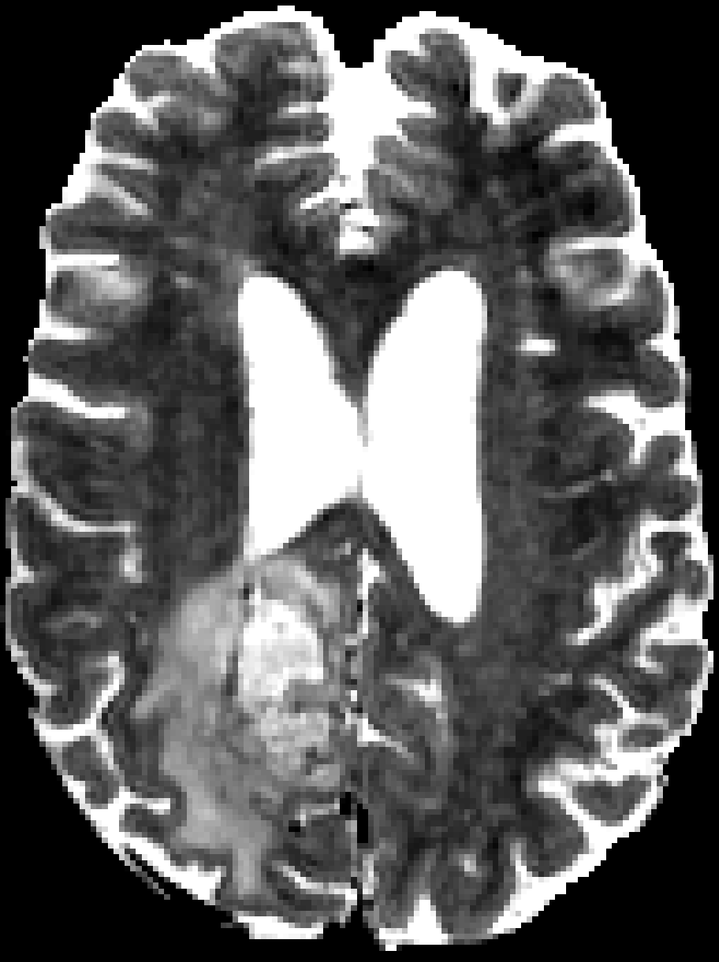 BraTS glioma, T2w input