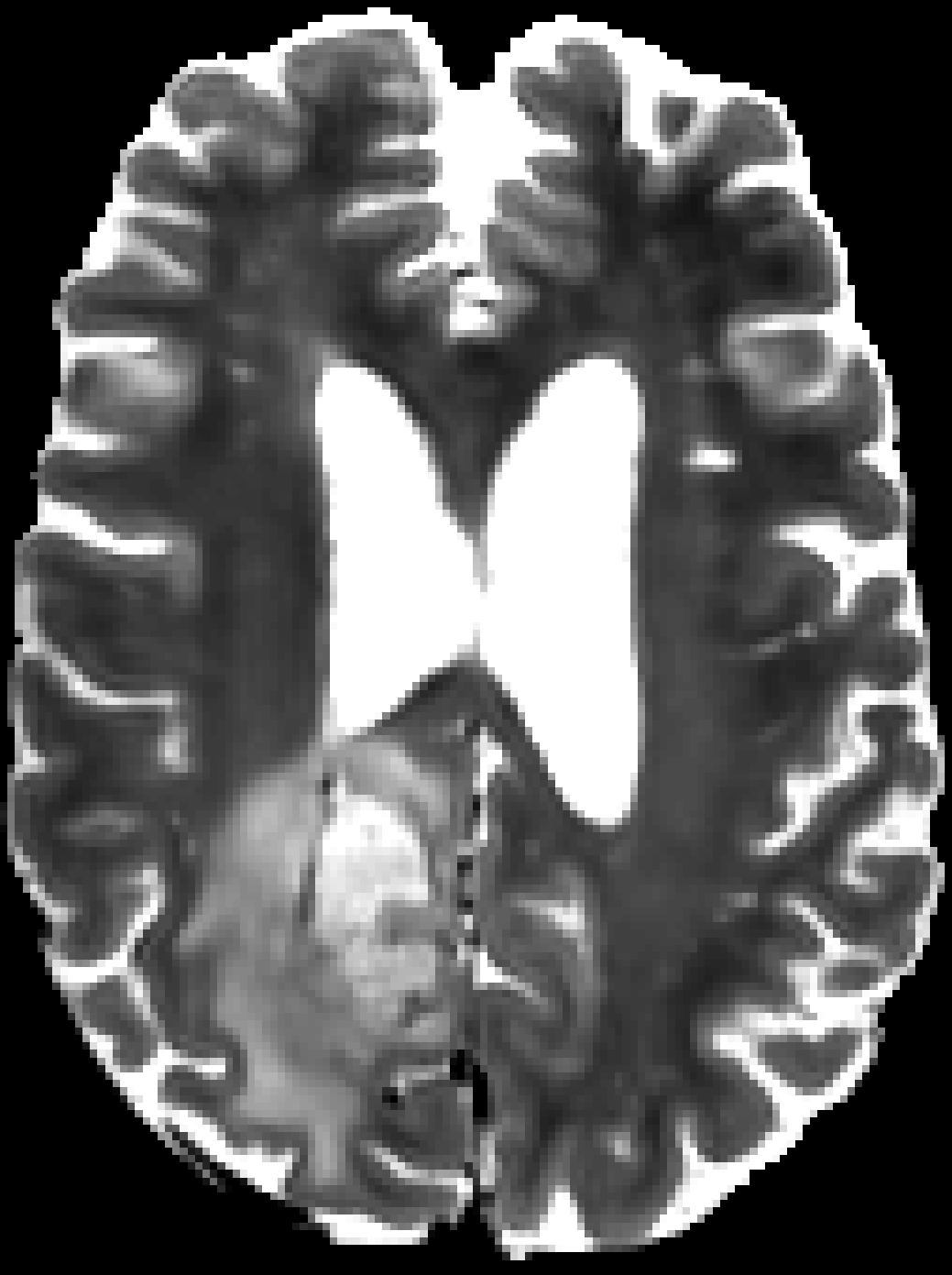 BraTS glioma, T2w denoised with YADO