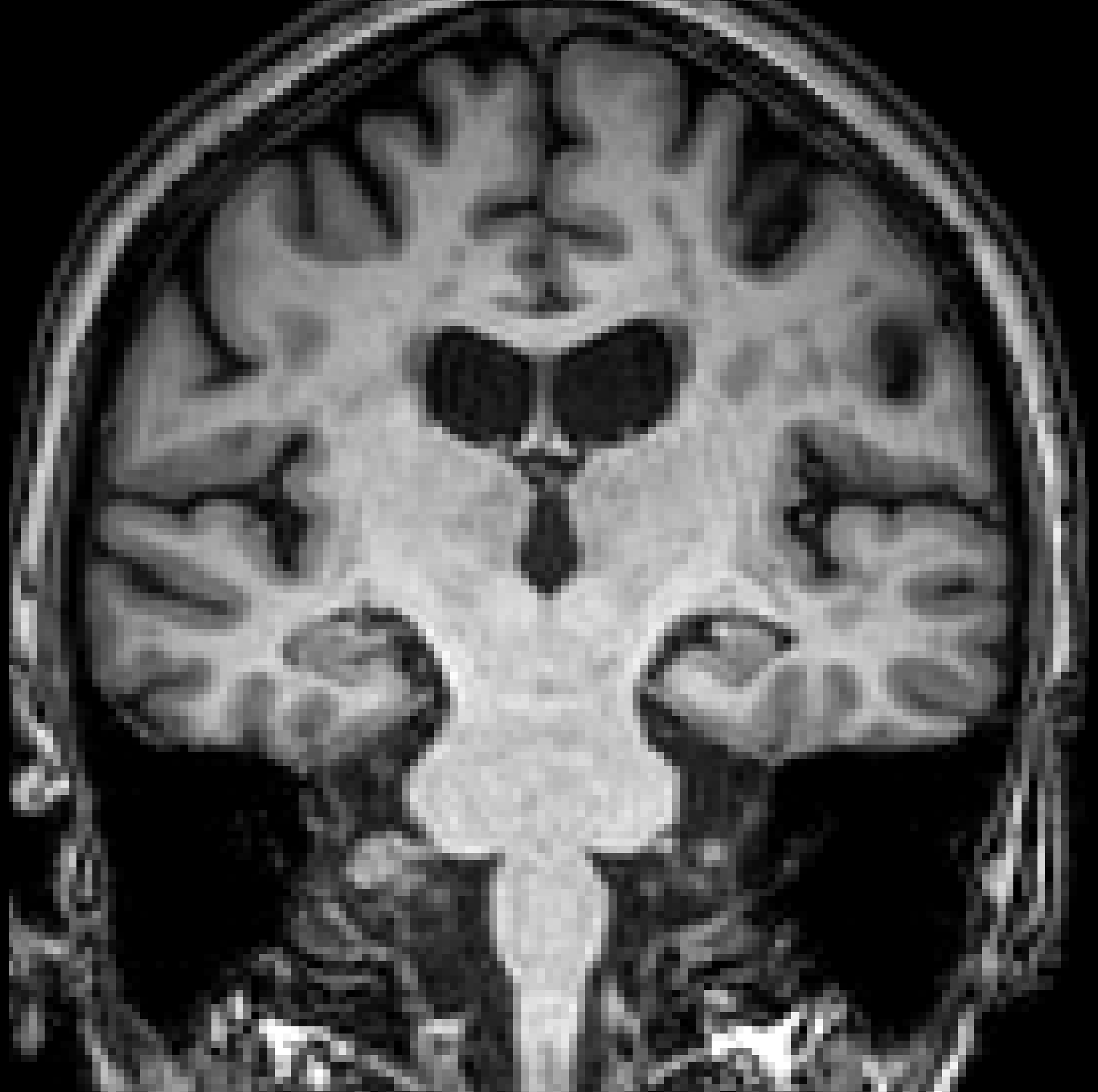 CHDI (Huntington's disease) input, single acquisition