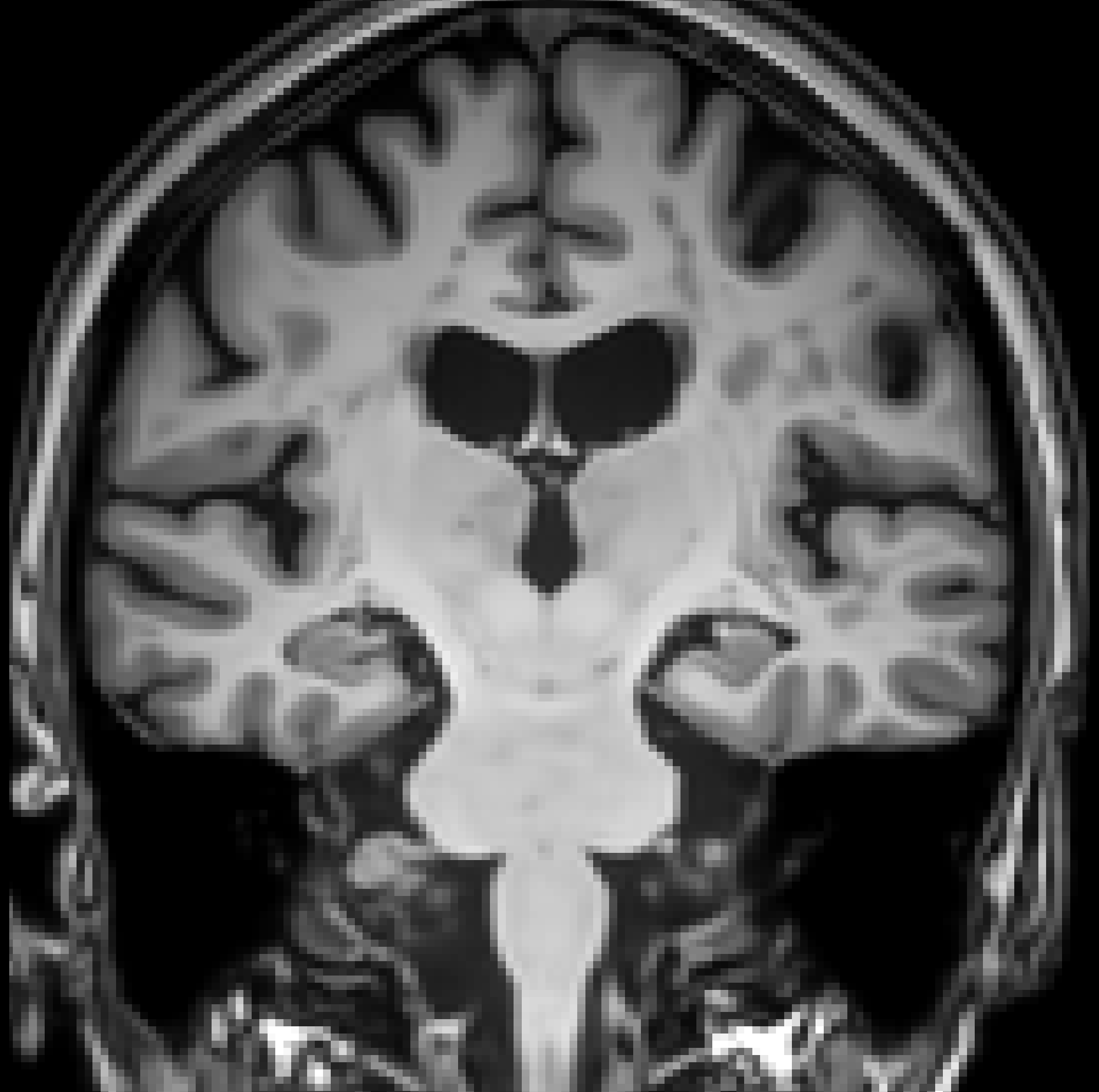 CHDI (Huntington's disease) denoised with YADO